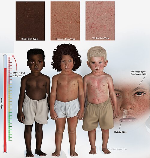 Appearance of measles in children with different skin tones